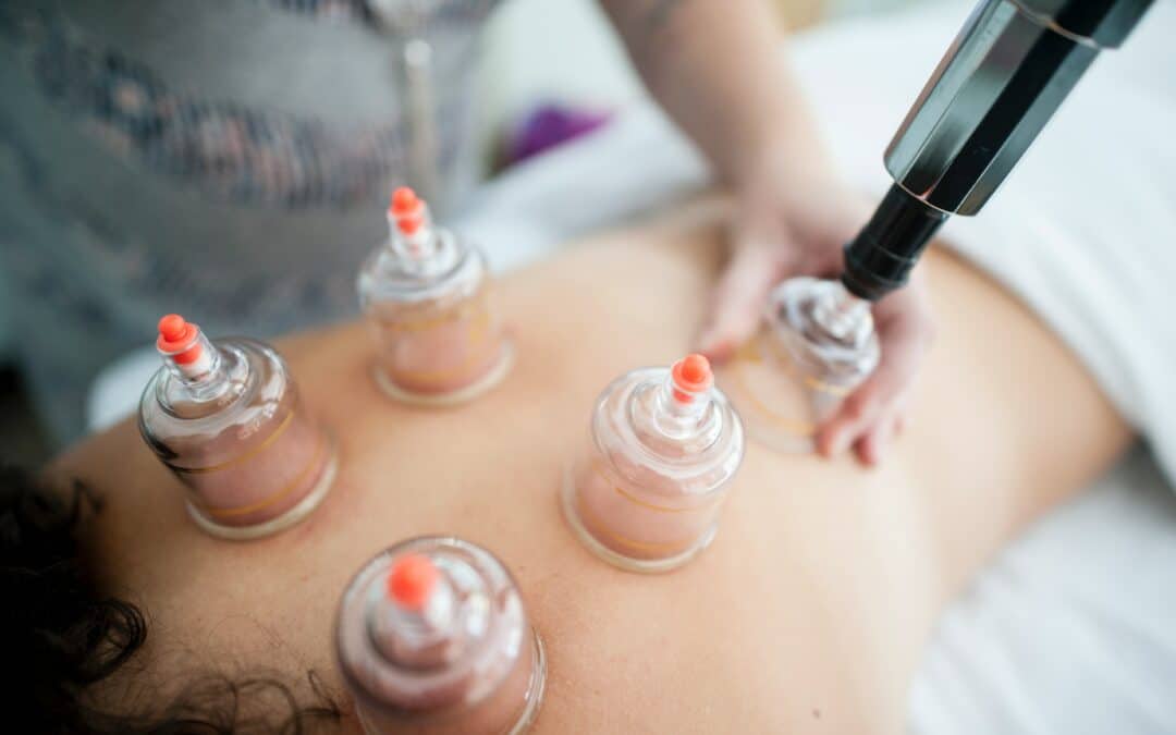 Cupping in Chiropractic Care
